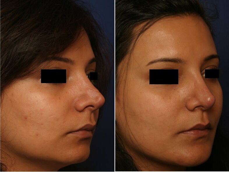 резултат от пластична хирургия