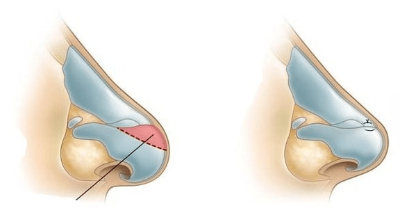 Корекция на формата на носа