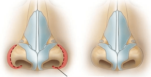 Намаляване на ноздрите