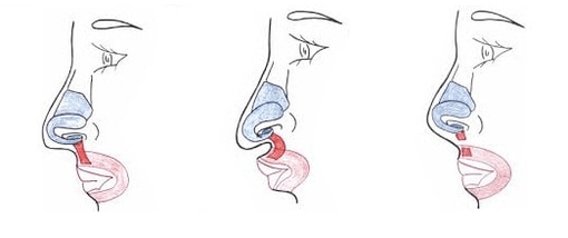 Срязване на част от носния мускул