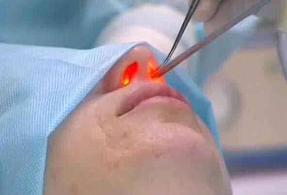 лазерна ринопластика на носа