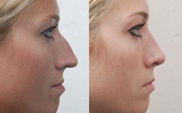 резултатът от ринопластика на носа