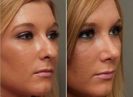 преди и след ринопластика на носа