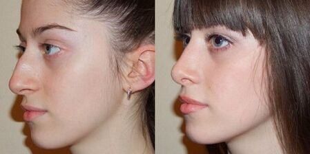 снимки преди и след ринопластика на носа