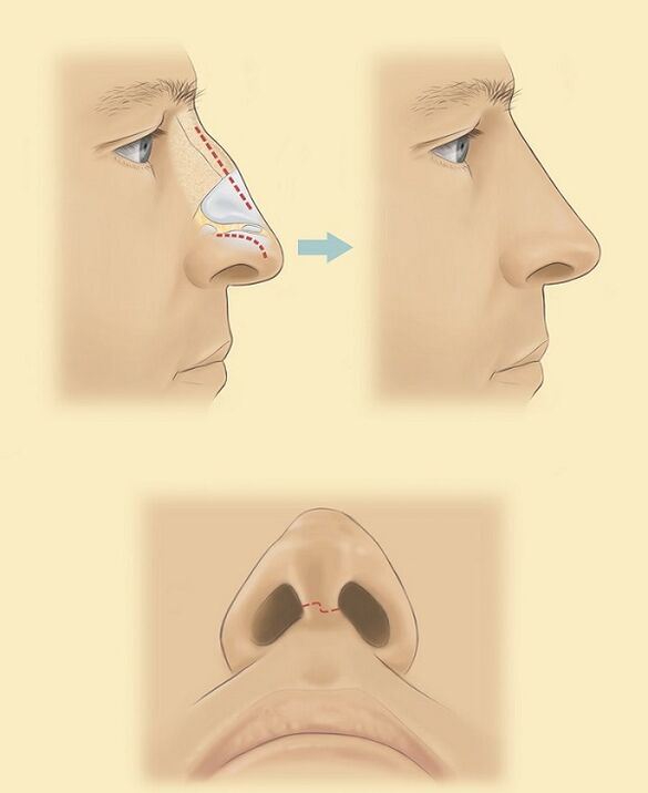 схема за ринопластика на носа