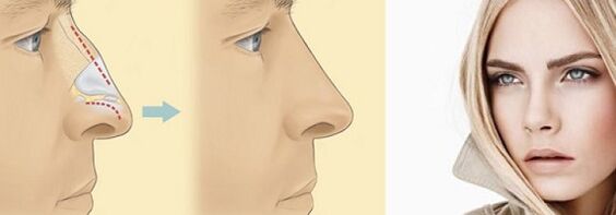 корекция на формата на носа с нехирургична ринопластика