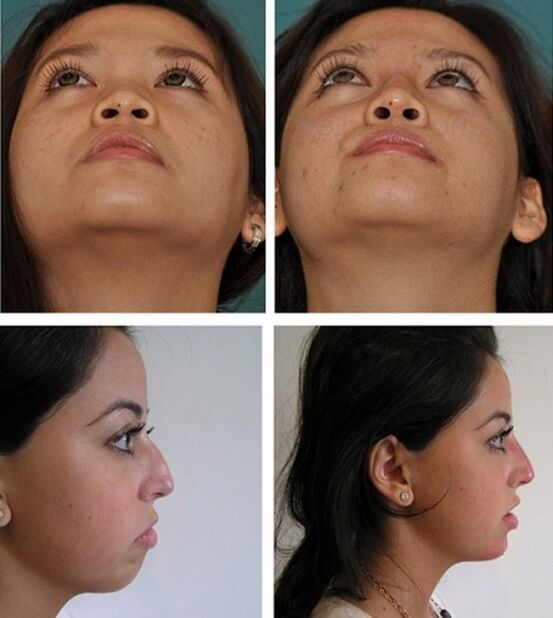 снимки преди и след ринопластика без операция