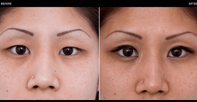 преди и след очна операция