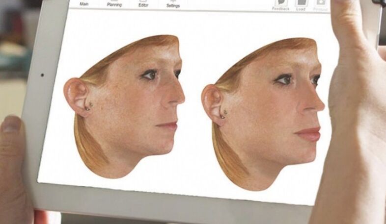 Метод за компютърно моделиране на носа преди ринопластика