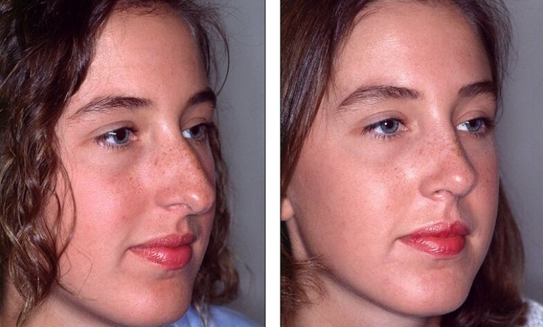 Нос преди и след неуспешна ринопластика