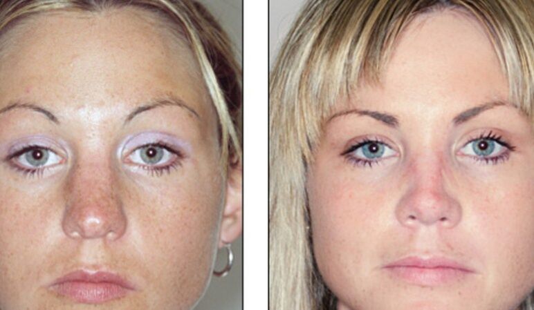 Преди и след неуспешна ринопластика на носа