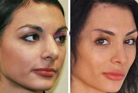 нос преди и след пластична операция