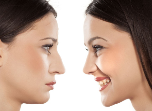 Ринопластика на носа преди и след
