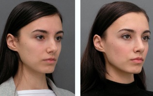 Момиче преди и след ринопластика на носа